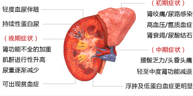 肾炎、肾功能不全、肾衰竭、尿毒症4个阶段，看看你属于哪个阶段!