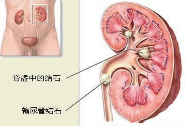 导致肾结石的原因