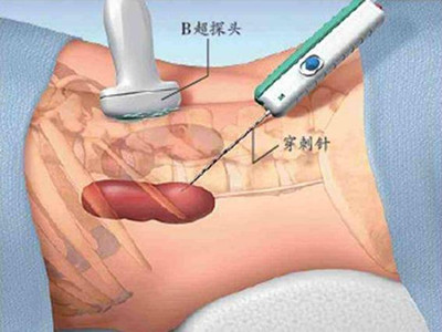 西安肾病医院专家介绍：肾穿注意事项