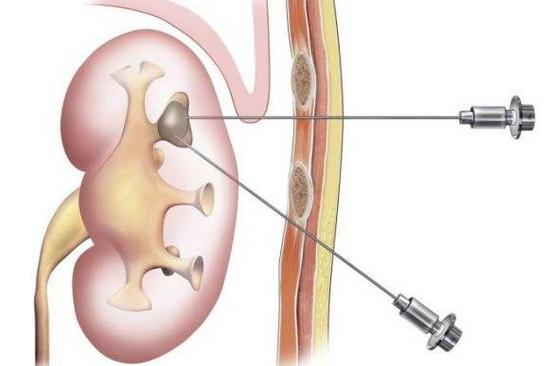 西安肾病医院专家介绍：肾穿注意事项