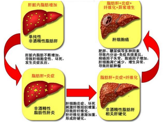 脂肪肝